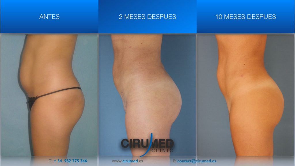 Aumento de glúteos con grasa propia sus resultados
