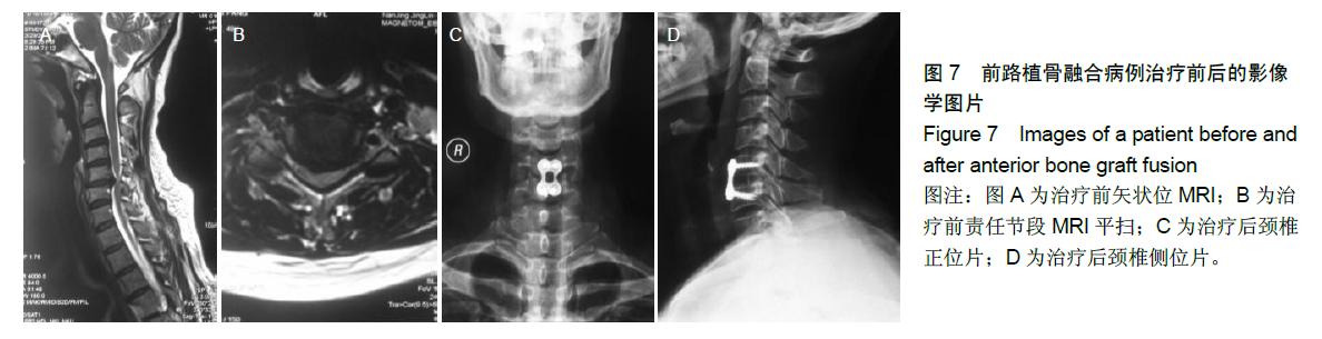 颈椎间盘置换与前路椎间植骨融合修复中年颈椎病：颈椎功能及活动度比较