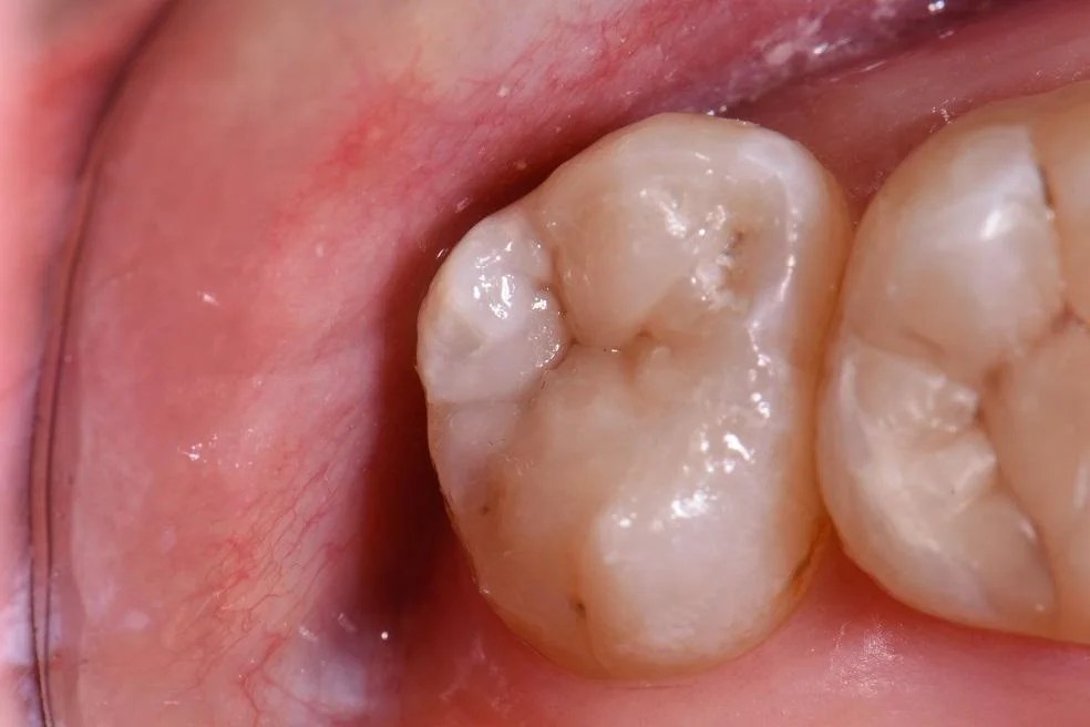 Posterior Composite Fillings Patient 50