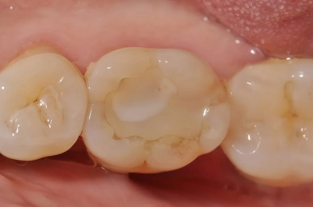 Posterior Composite Fillings Patient 15