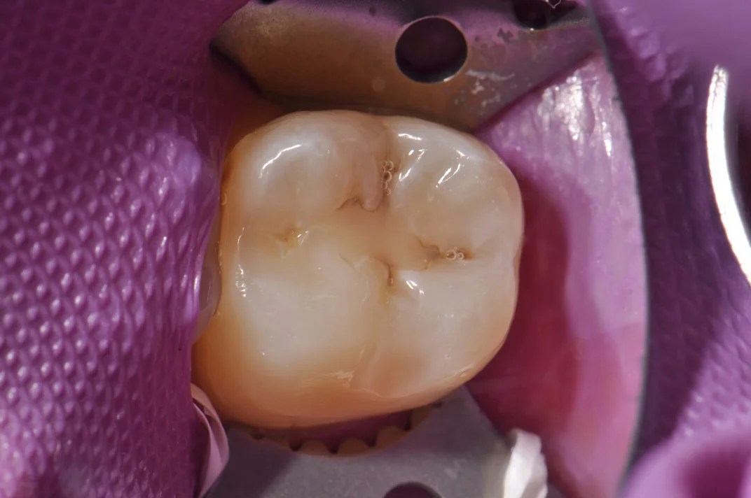 Posterior Composite Fillings Patient 17