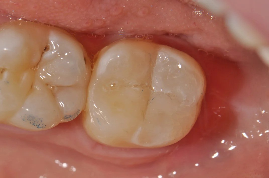 Posterior Composite Fillings Patient 17
