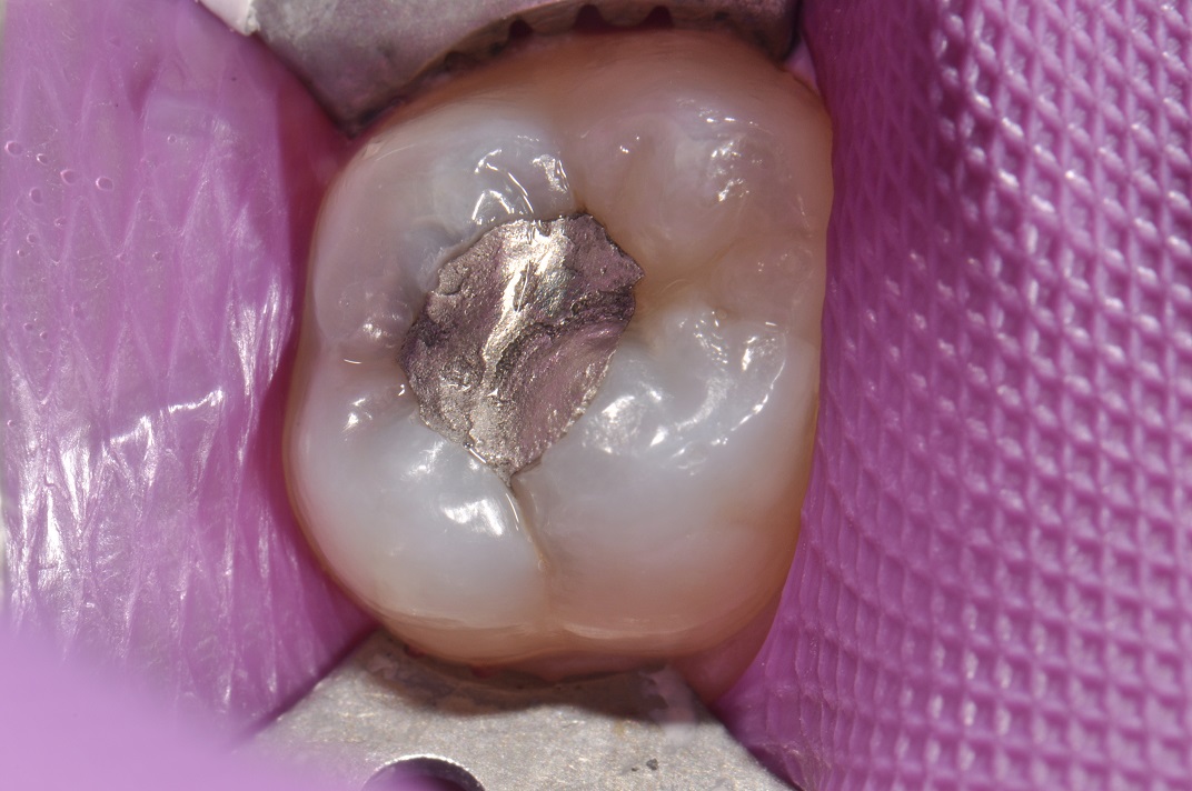 Posterior Composite Fillings Patient 28