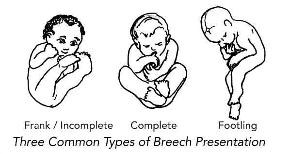 My Breech Baby How to Turn a Breech Baby