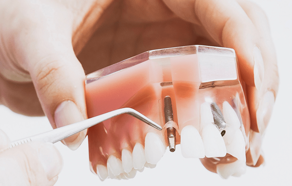 Dental Implants With Dr. Latif Dentist in Columbus, OH