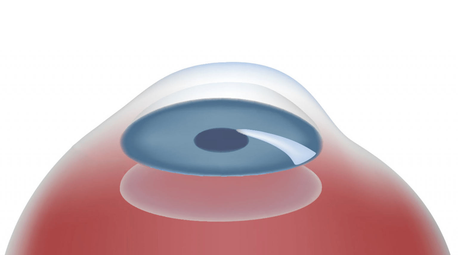 Lens Implant Surgery Clearsight Eye Centre