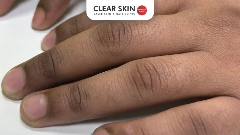 How to Get Rid of Dark Knuckles Fast and Permanently?