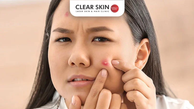 Blind Pimple Causes 6 Reasons You Must Know