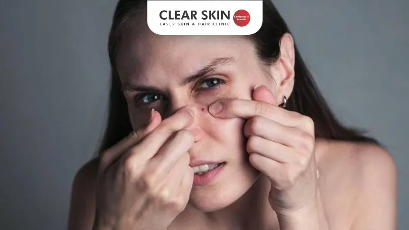 Blind Pimple How Do You Get Rid of Pimples that are Under the Skin?