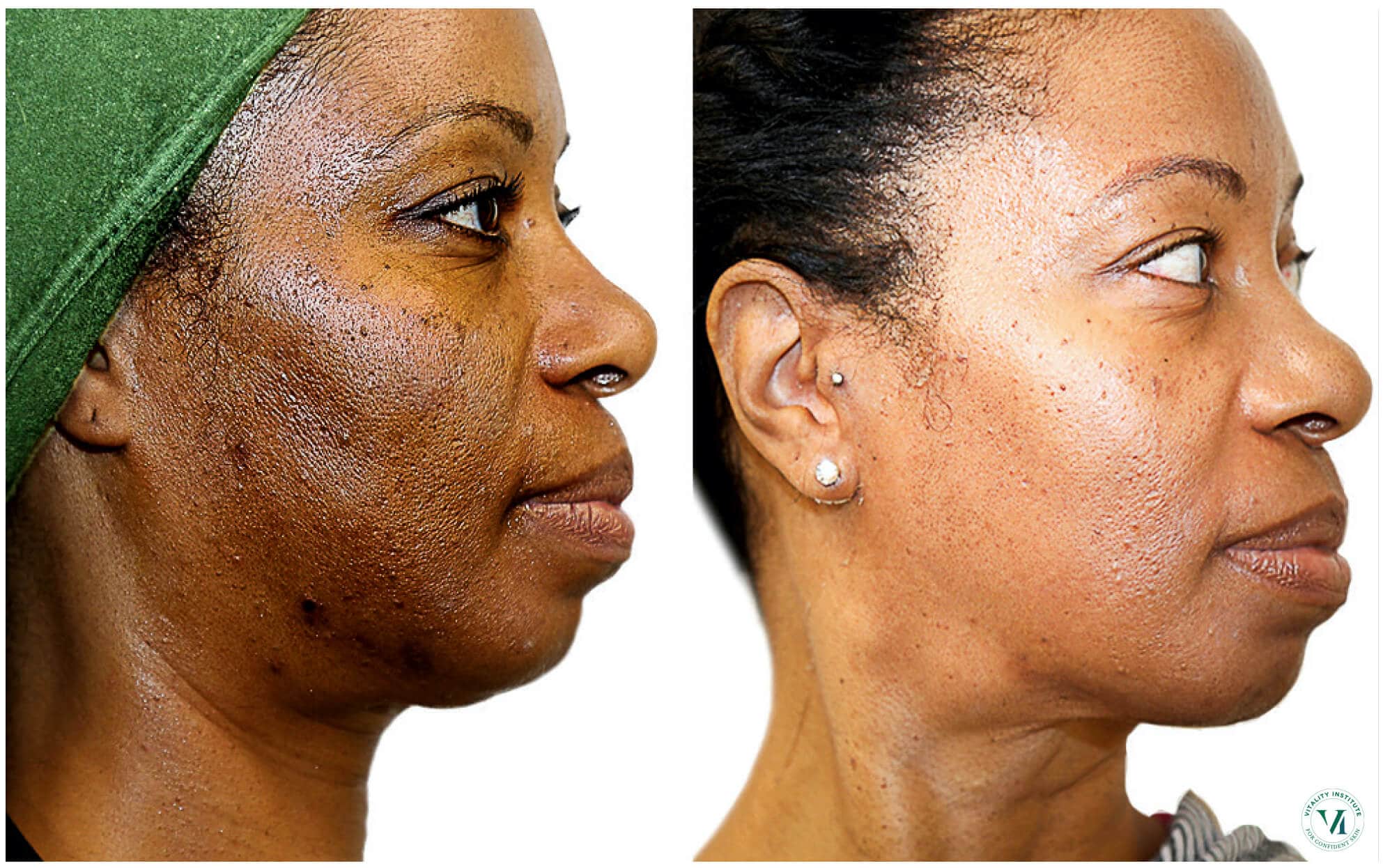 Facial Services Greenville Chemical Peels Clemson Eye