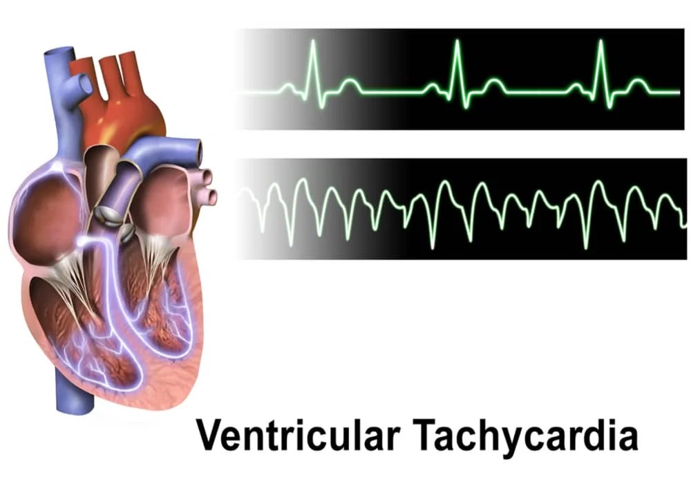 Tachycardia fast heartbeat Symptoms, Diagnostics, Causes, Treatment