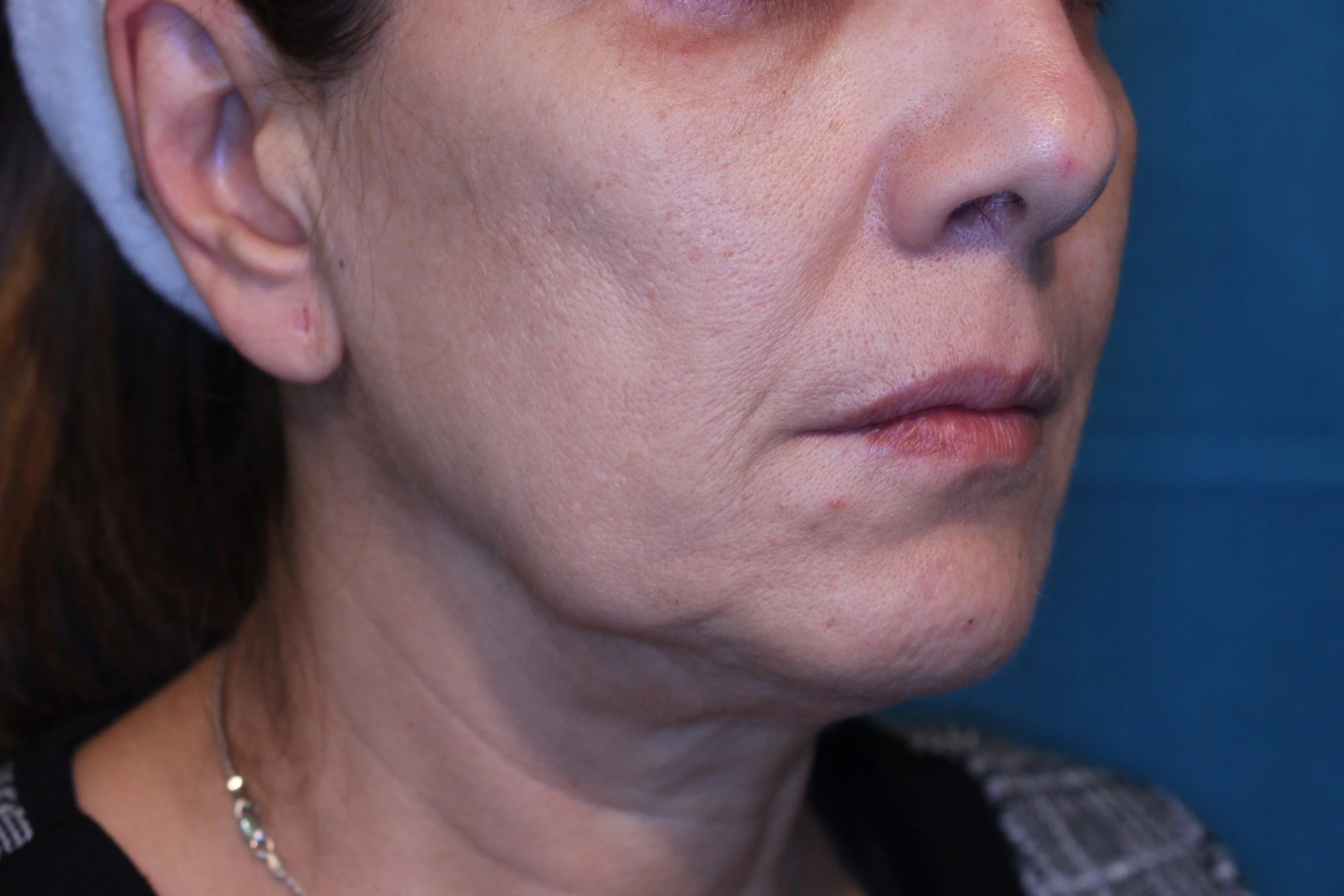 ¿Cuánto tiempo duran los resultados de un lifting? ≫ Clínica Fernández