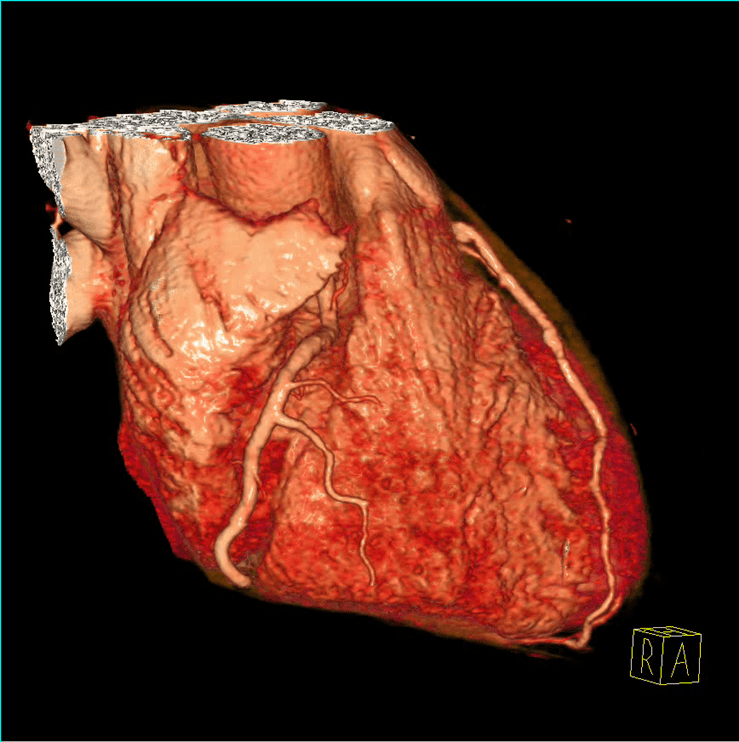 Noninvasive Cardiac Imaging Coronary CT Angiography