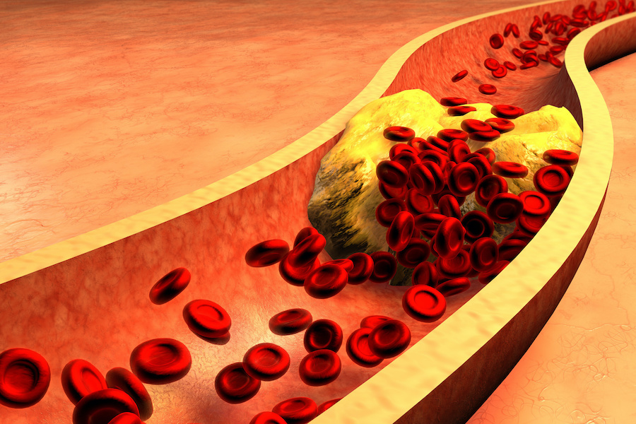 NHS cholesterolbusting jab to save thousands of lives