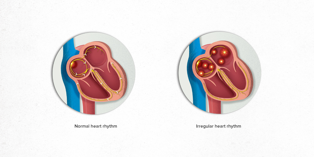 What is Atrial Fibrillation? Hospital Clínic Barcelona What is Atrial Fibrillation? Hospital Clínic Barcelona