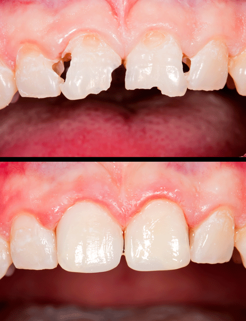 Composite Fillings Dentist Linton