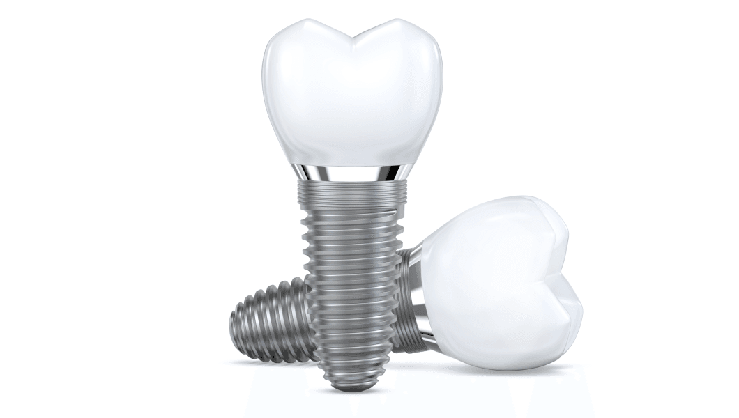 Understanding Your Options Different Types of Dental Implants Clock