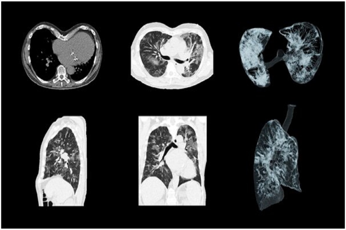 Role of CT Chest and Teleradiology for 30 Minute Report in Current