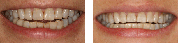 Patient Photos Clovis Cosmetic Dentist