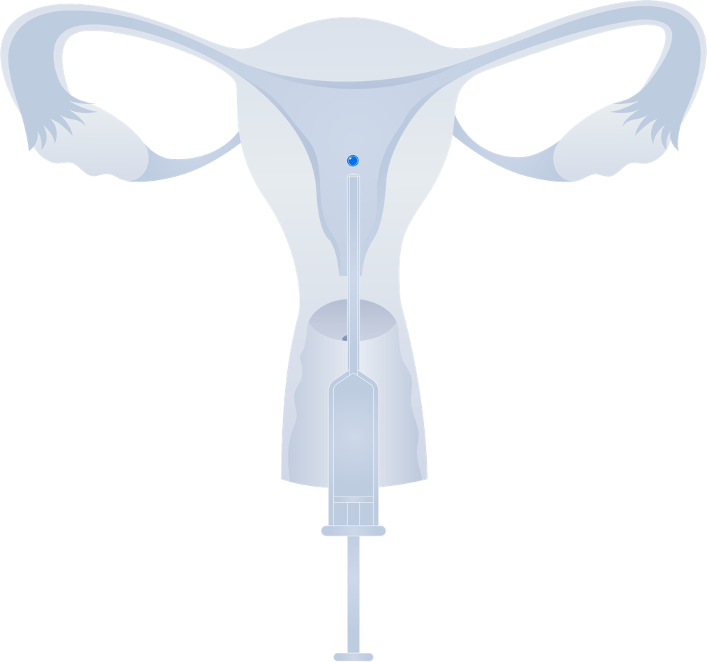 IVF What is In Vitro Fertilization CNY Fertility