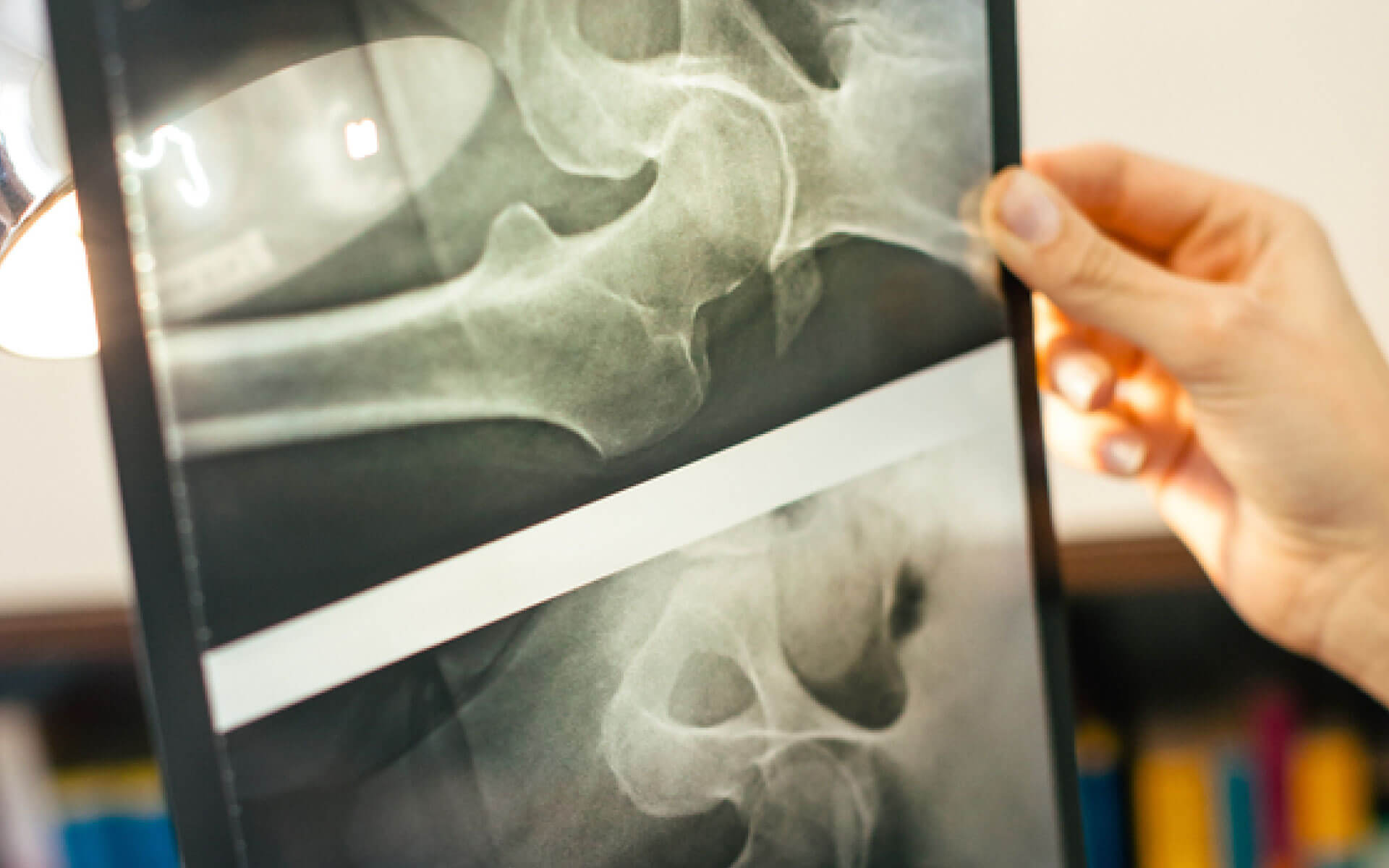 HOOS JR and KOOS JR PatientReported Measures