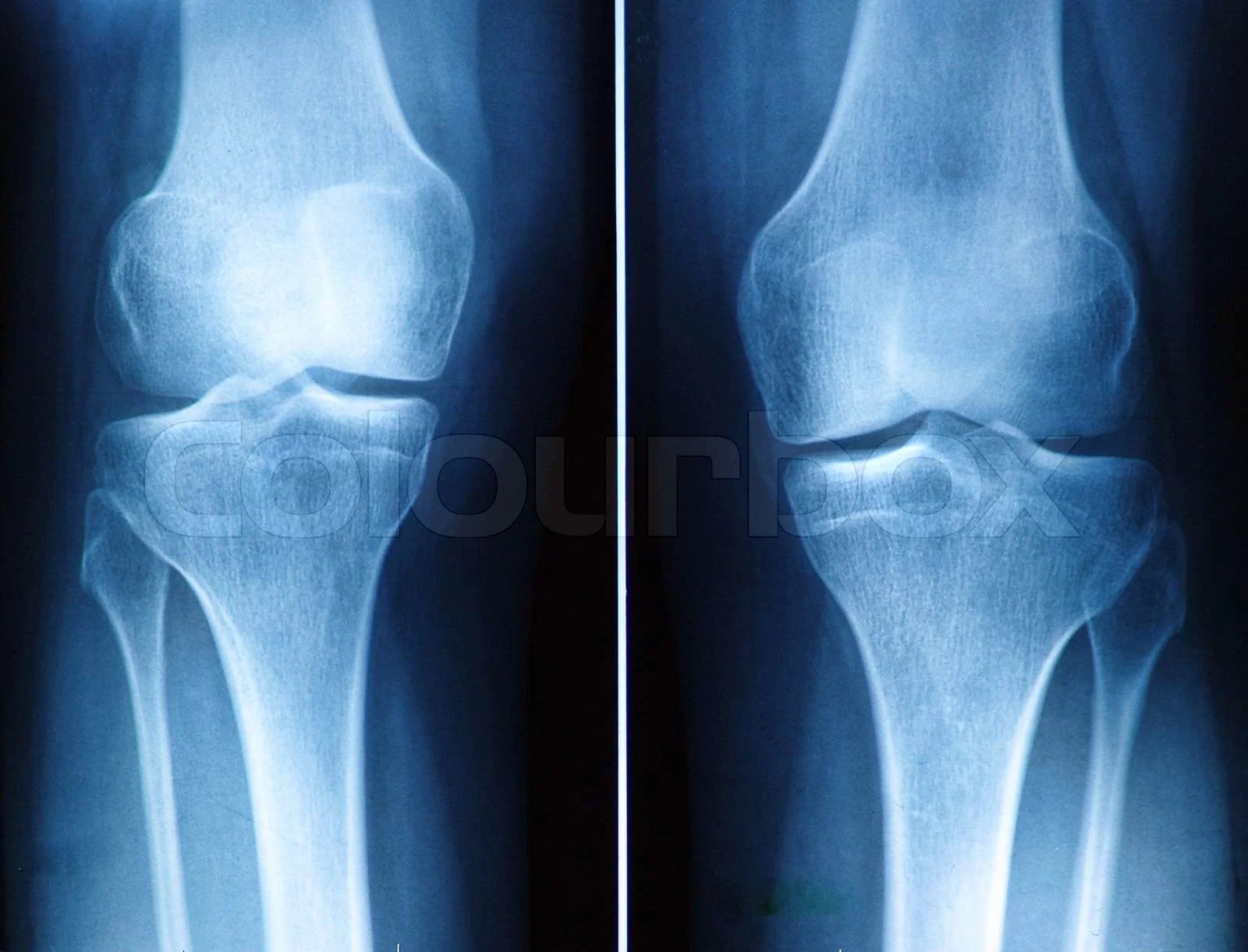 Knie Röntgen Stockfoto Colourbox