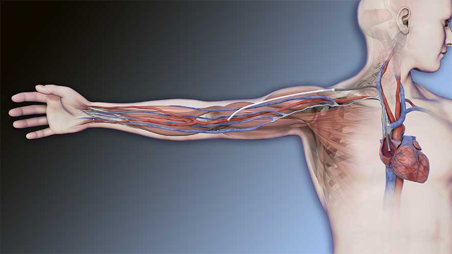 Implantes de HeRO GRAFT realizados en España Commedcor