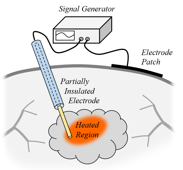 Study Radiofrequency Tissue Ablation Using Simulation COMSOL Blog