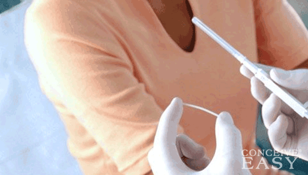 Is it possible to get pregnant on Nexplanon? ConceiveEasy