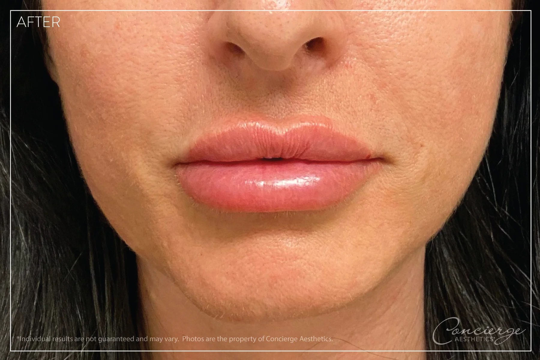 Before and After Photos Botox and Juvederm Concierge Aesthetics