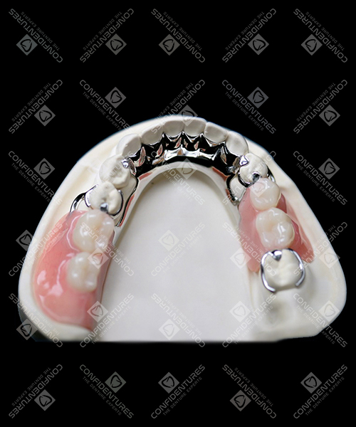 Titanium Lower Partial Denture Price Confidentures The Denture Experts
