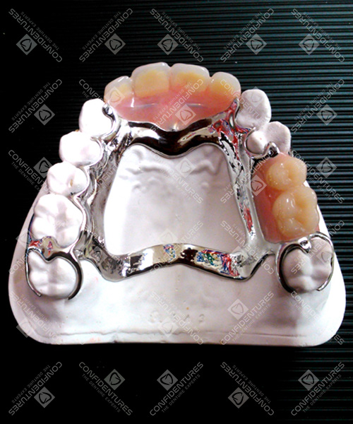 Titanium Upper Partial Denture Price Confidentures The Denture Experts