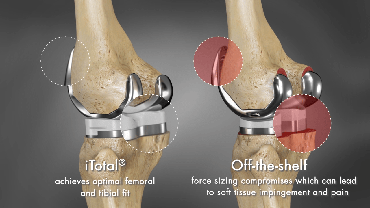 Why custom form and fit are critical to restoring function and
