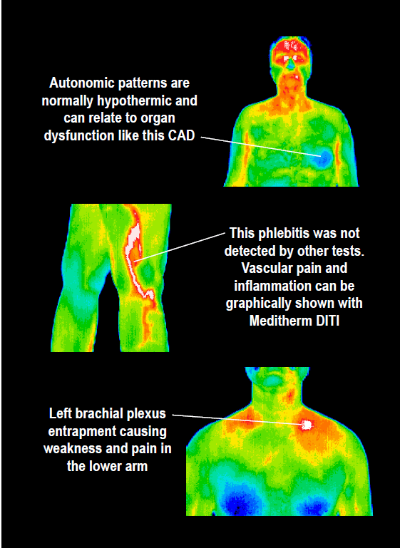 Thermography and its use in Cancer Care Conners ClinicConners Clinic