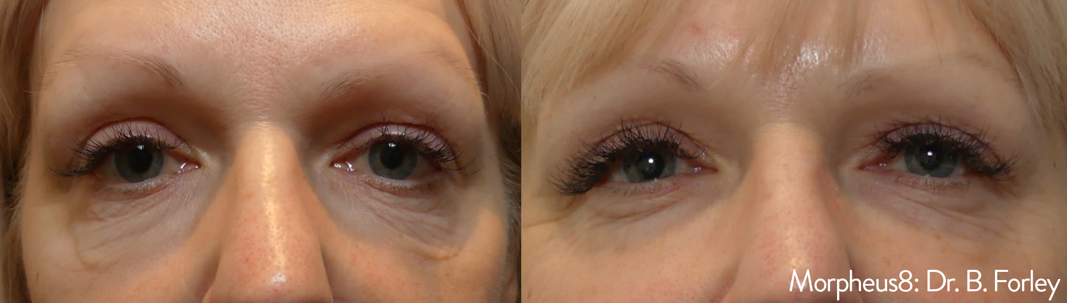 Morpheus8 RF Microneedling Conroe Aesthetics Weight & Wellness