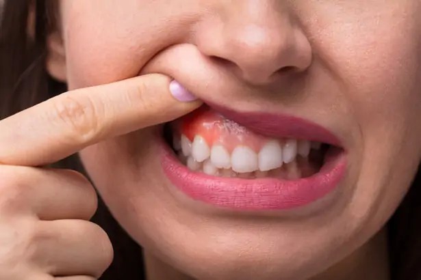 Gencive gonflée ? Causes et remèdes