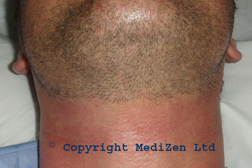 Laser & IPL Hair Removal Treatment Cost, SideEffects Information