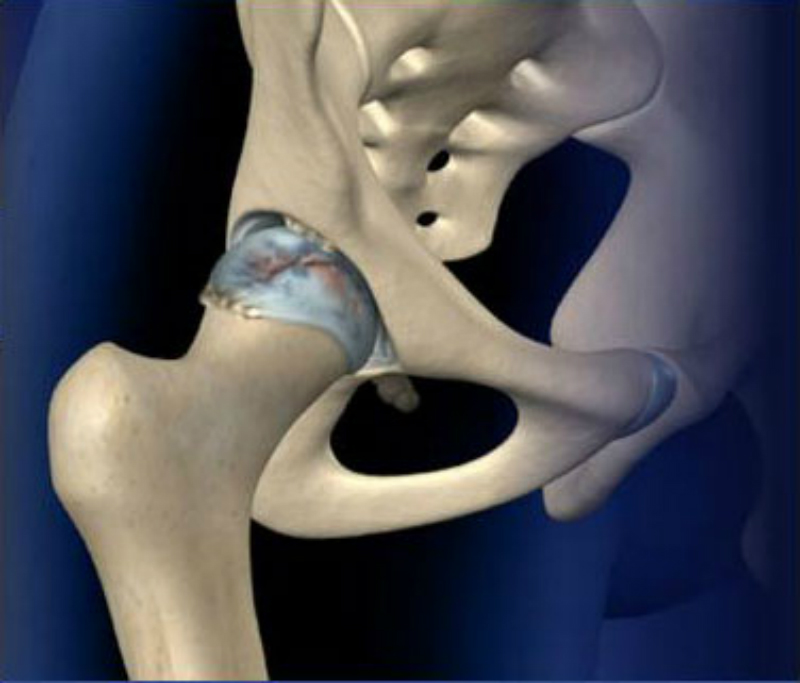 Managing Your Chronic Hip Pain with Treatments Tailored to You