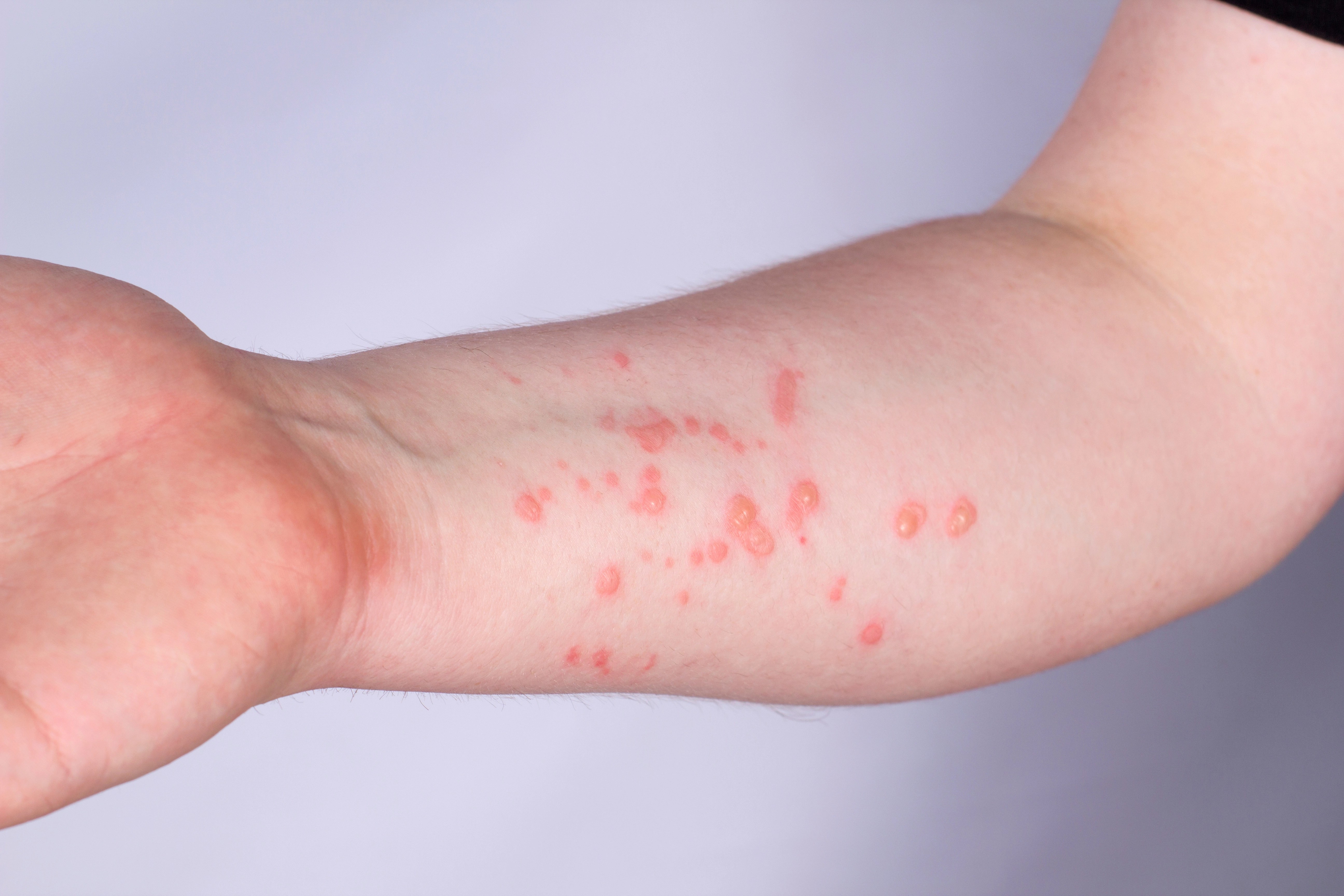 Monkeypox · Conway Medical Center