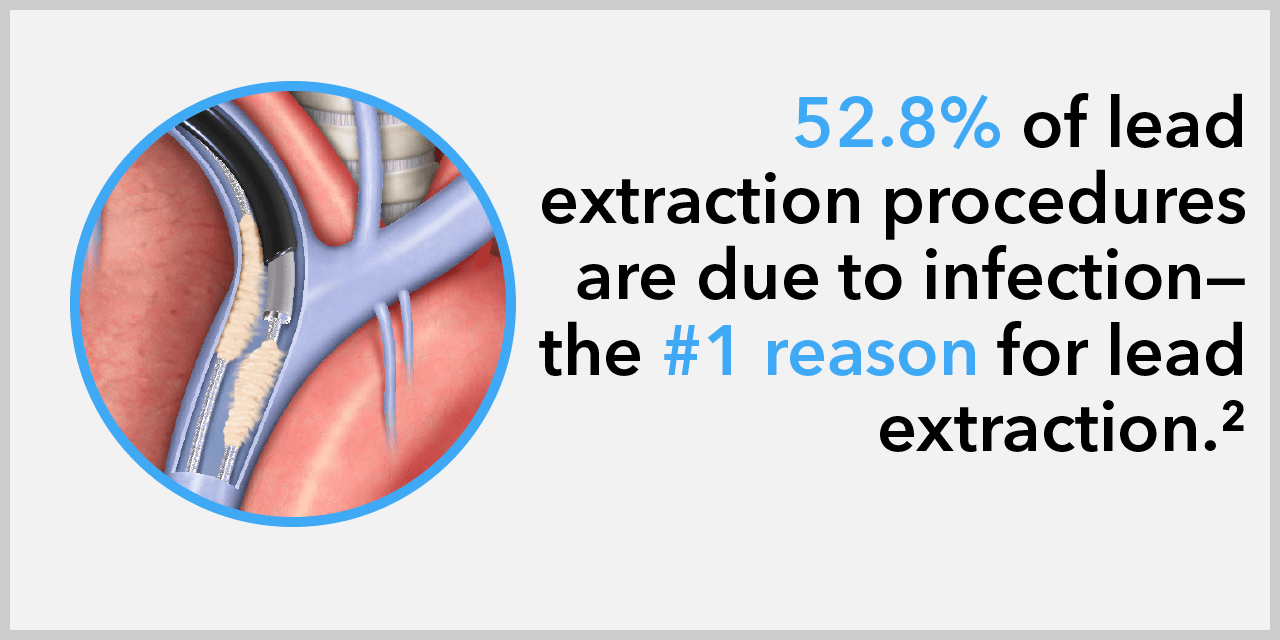 Reasons for lead extraction Cook Medical