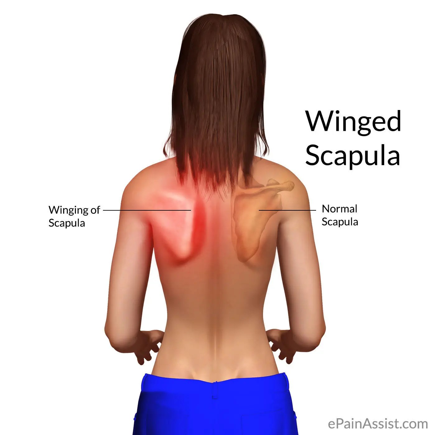 The risk behind Scapula Winging or a Protruding Shoulder Blade
