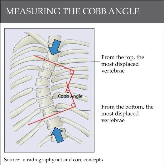 Measuring the Cobb Angle