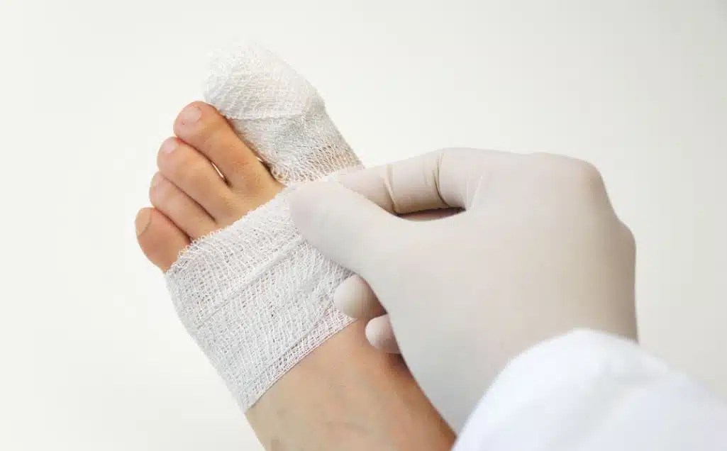 Laser Corn Removal Surgery