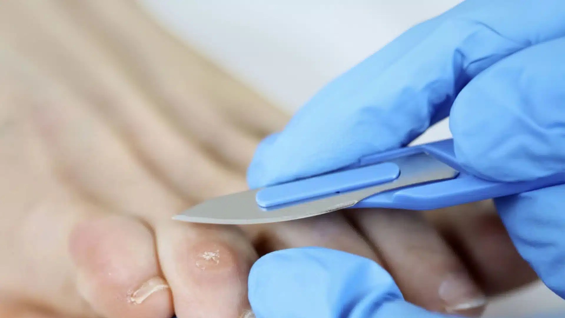 Surgery Corn Removal Corn Removal Surgery