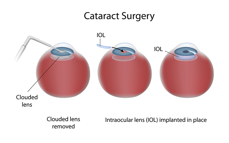 Cataract Surgery vs. LASIK Which Procedure is Better for You