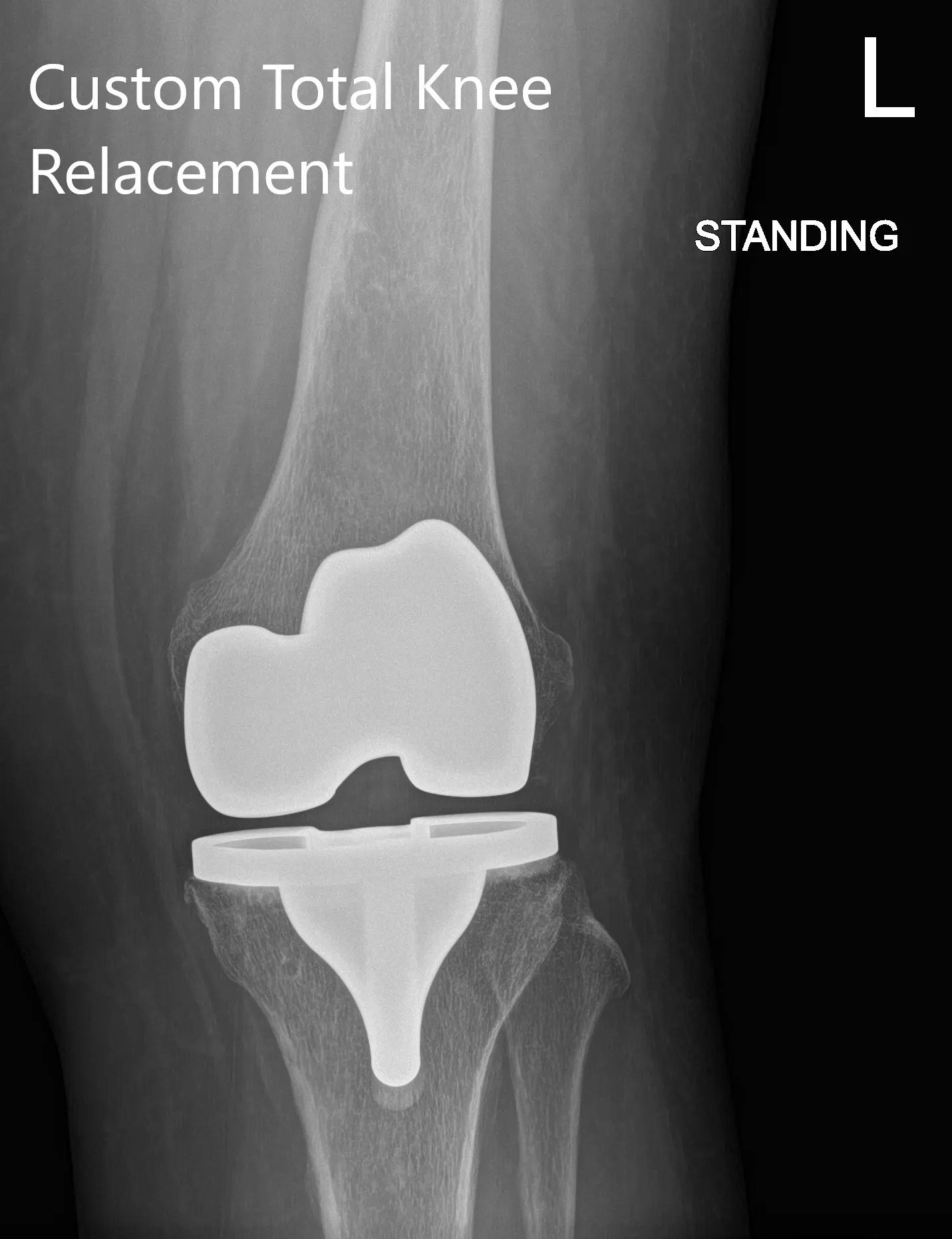 Case Study Customized Total Knee Replacement in a 59yearold male