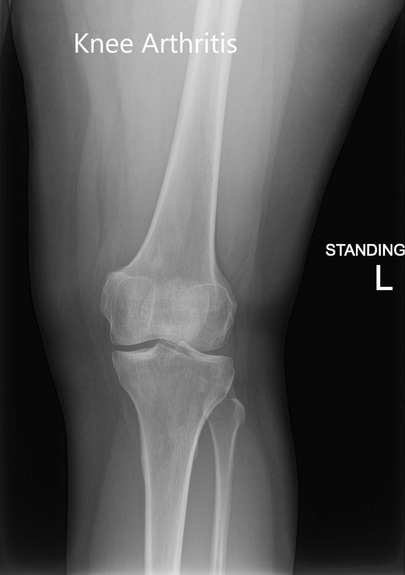 Case Study Custom Left Knee Replacement for Post