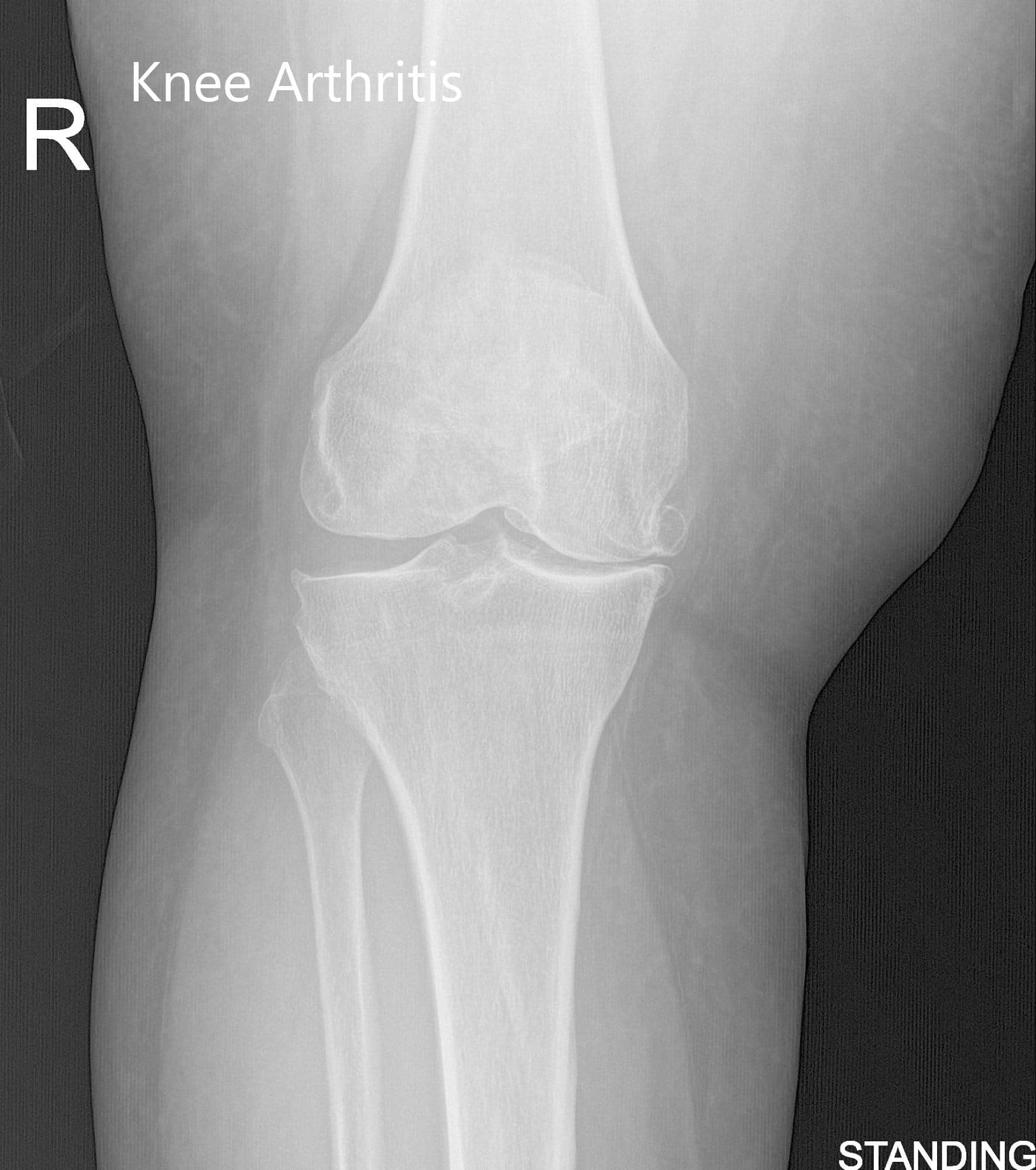 Case Study Custom Right Total Knee Arthroplasty 62yearold male Complete Orthopedics