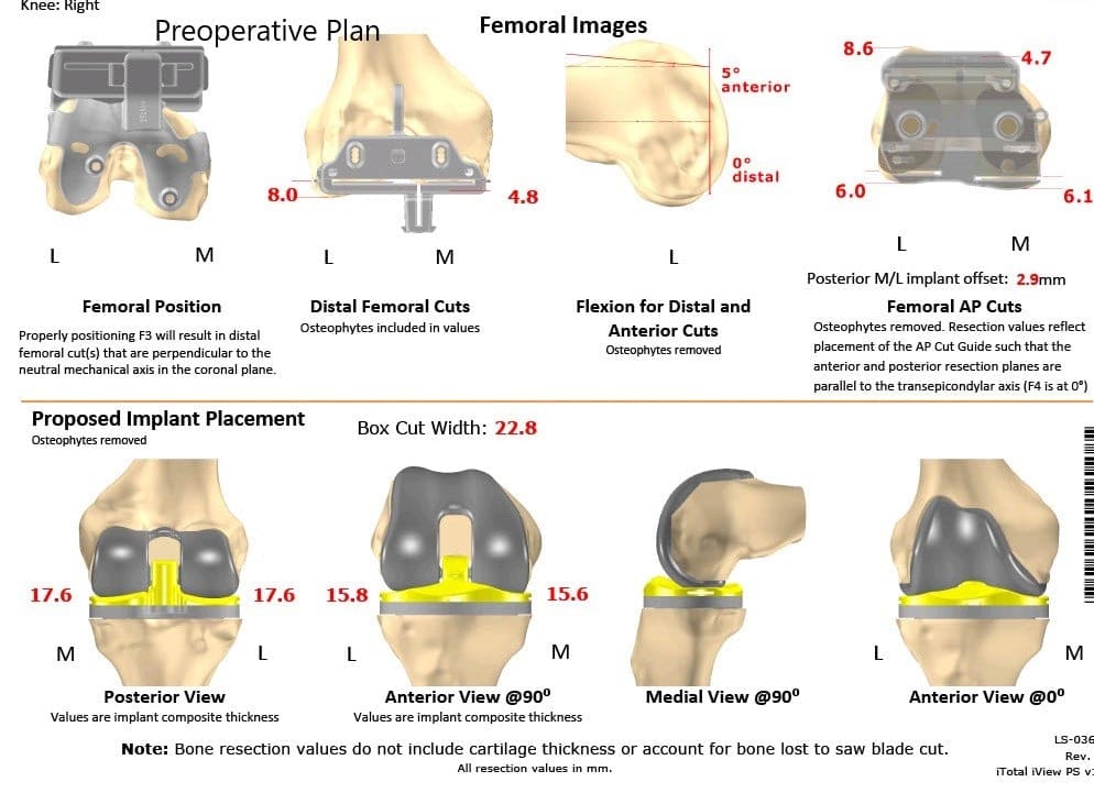 Total Knee Replacement Surgery Recovery Timeline