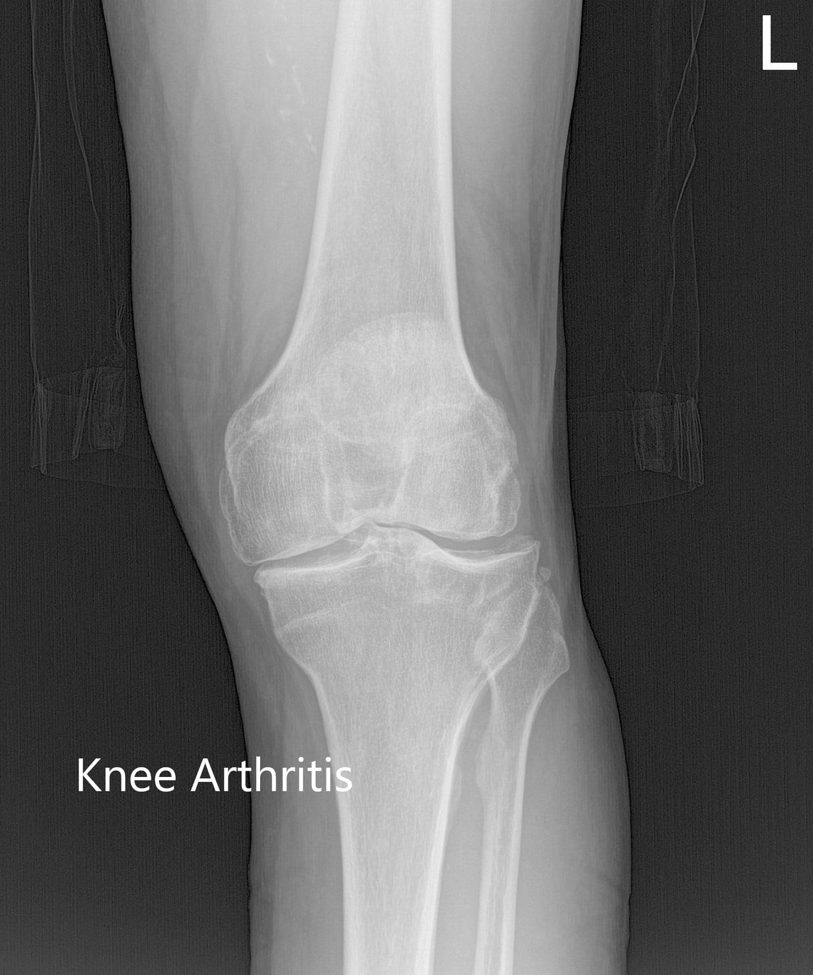 Case Study Custom Left Knee Replacement in 68 yr. Old Female